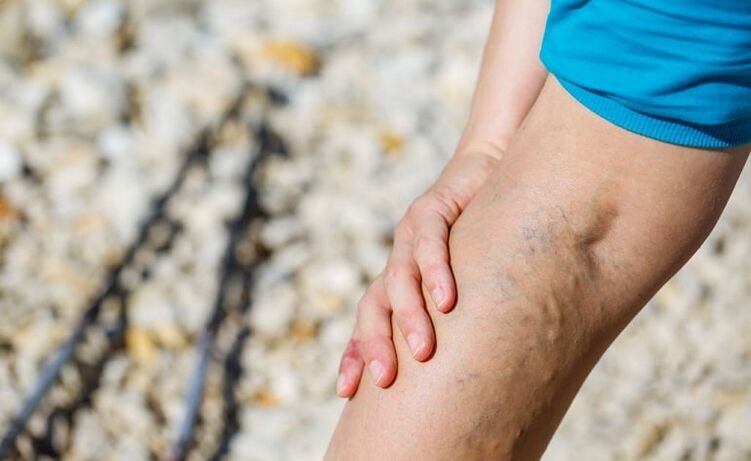 Varicose veins on the leg